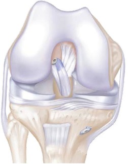 ACL reconstruction Intrafix