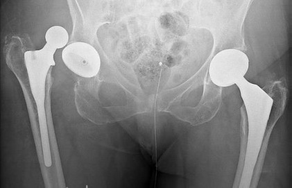 C0103496-Dislocated hip replacement, X-ray-SPL